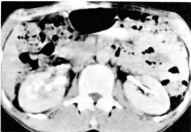 Fig.  7.  Loss  of  the  renal  sinus fat  and  focal calyecta- calyecta-sis  of  rig ht  kidney 