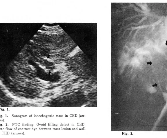 Fig.  2.  PTC  finding.  Ovoid  filling  defect  in  CHD  Note  flow  of  contrast dye  between  mass  lesion  and  wall 