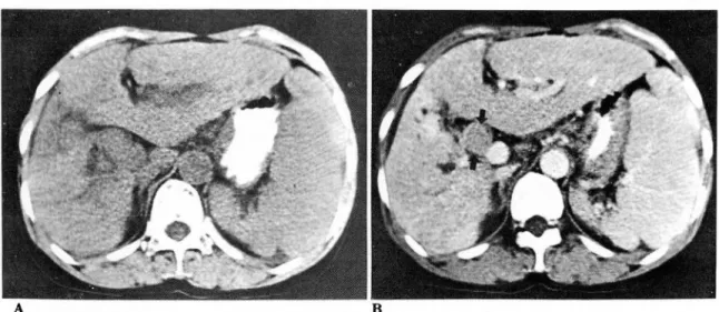 Fig. 3.  Pre  (A)  and  Post  (B) contrast  CT finding.  Isodensity  mass  (arrows) within  CHD  is  not enhanced