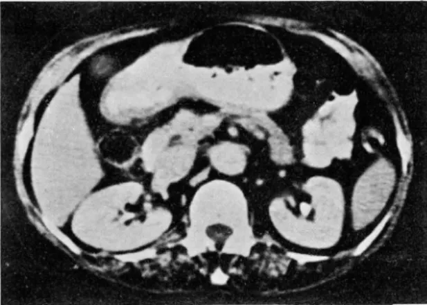 Fig.  2.  Stomach  cancer ,  Stage  n 
