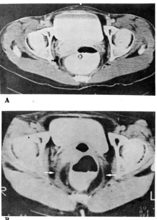 Fig.  1.  A.  Preirradiation  CT  scan.  B.  Postirradiation  CT  scan ,  5  months 