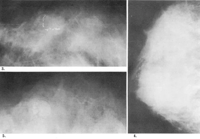 Fig.  4.  Breast  Abscess 