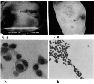 Fig.  6.  Bre ast  Carcin oma 