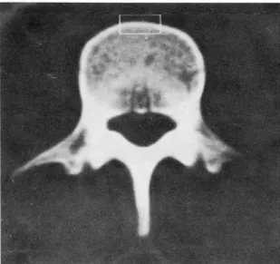 Fig.  1  CT  scan  through  th e  mid-portion  of  L3.  Wh ite  line  of  re ctangular  form  del ineates  th e  area  of  corti cal  bone  of  the  ante ri or  portion  of  verteb ral  body