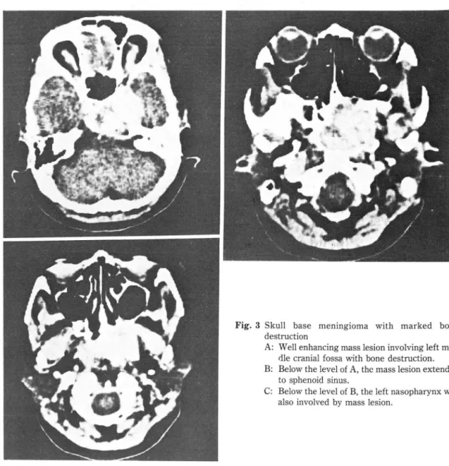 Fig.  3  Skull  base  meningioma  with  marked  bone  destruction 