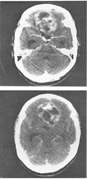 Table  1.  Correlation of CT Findings with Pathological  Fin- Fin-dings  (According  to  Rus능e ll's  Criteria) 