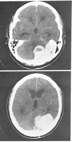Fig.  2.  Well  defined ,  irregular  shaped  mass  with  some  focallow density zones on left posterior fossa ,  caus  ing  deforming  and  displacing  4th  ventri c1 e ‘ 