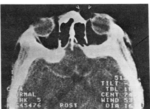 Fig.  3.  CT scan shows round ,  fat  density mass with con. 