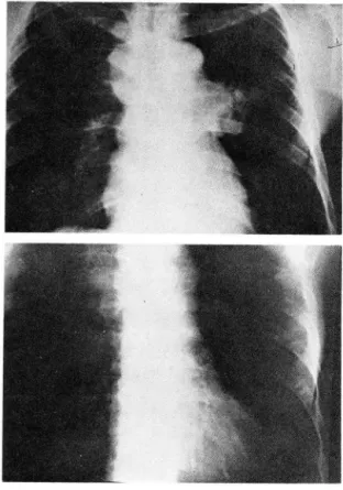 Fig.  2.  Peripheral  infiltration  type 