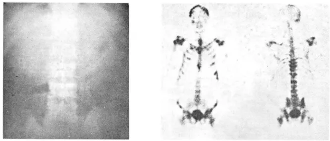 Fig.  1.  (A)  Osteoblastic  metastasis to  thoracic  and lumbar  spine  is  presen t