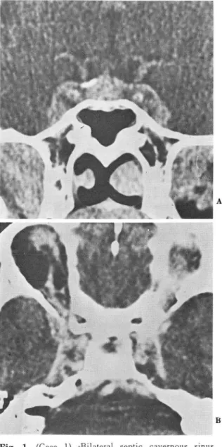 Fig.  1.  (Case  1)  -Bilat eral  septic  cavernous  sinus  thrombophlebitis  with  multiple  defects  A
