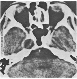 Fig.  5.  (Cases  12)-Trigeminal  neurinoma 