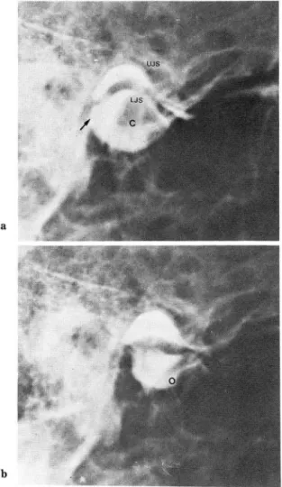 Fig.  1.  Norma l.  UJS:  upper  joint  space ,  LJS:  lowe r  joi nt  space ,  C:  Closed ,  0:  ope n(arrow;  con