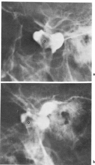 Fig.  2.  Anteri or  disc  displ acement  with  reduc tion 