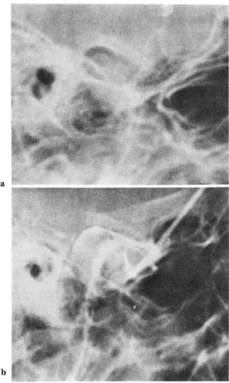 Fig.  5.  Disc  pe rforati on;  Bony  e rosio n  on  th e  poster. 