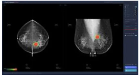 Fig.  2.  Lunit  INSIGHTMMG
