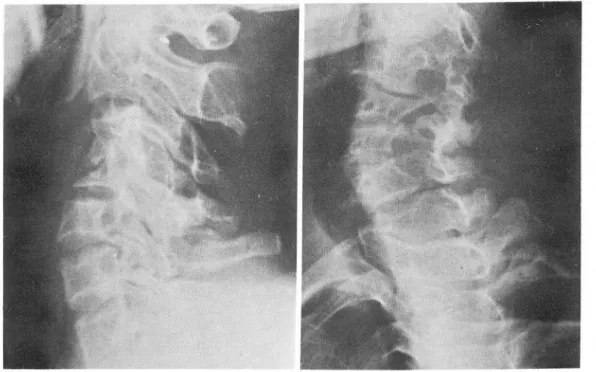 Fig.  1.  Cervical  radiograph ,  lateral  &amp;  LAO  view.  There is  widening  of  intervertebral  foramen  from  C2-3  to  C5-6  C-4  body  is  collapsed_ The  prevertebral  space  widened