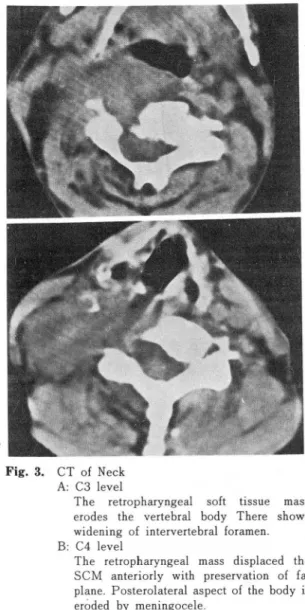Fig.  3.  CT  of  Neck  A:  C3  level 