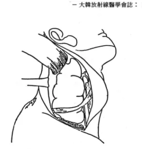 Fig.  5.  UIÌder  the  sternocleidomastoid  muscle ,  a  large  mass  lesion  with  its  white  surface  was  found