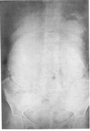 Fig.  1.  KUB:  A  huge  ro und  soft  tissue  mass  in  ri ght  uppe r  abdomen  with  pe riphe ral  rim  and  so me  granular  calcifi cation 