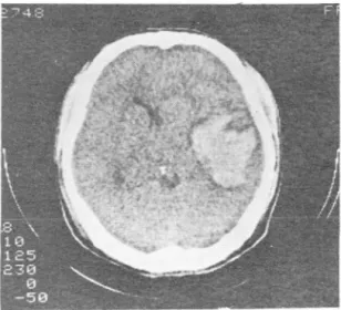 Fig.  4.  A  case  of  intracerebral  hematoma 