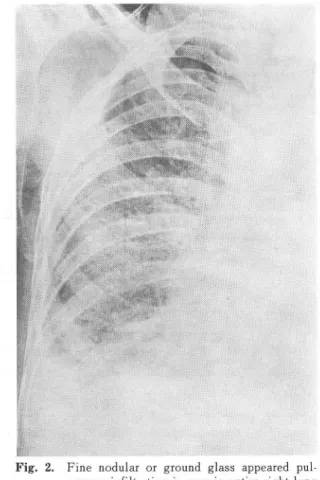 Fig.  2.  Fine  nodular  or  ground  glass  appeared  pul  monary  infiltration is  seen in  entire  right  lung  field 