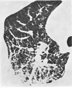 Fig.  6.  Hig h  resolution  CT( 1. 5mm  slice  thic kness ,  18  c m  fie ld  of  view ,  high spatial  frequency  reco  n-struction  algo rithm,  140KVp ,  170 mA,  3   se-cond)  of  right  upper  lung