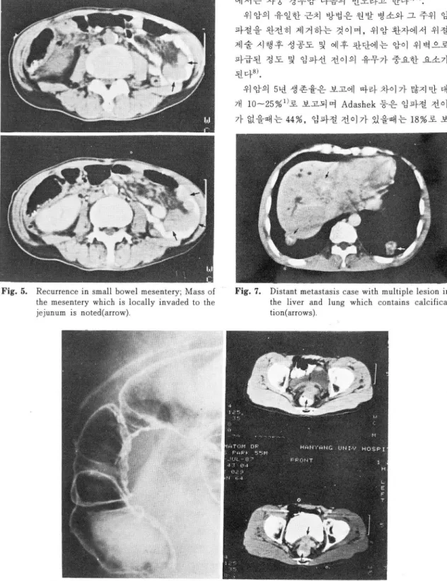 Fig.  7.  Distant  metastasis  case  with multiple  lesion  in  the  liver  and  lung  which  contains   calcifica-tion(arrows) 
