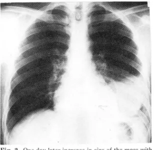 Fig.  1.  P lI llllonary  leionη  osarC0111ét 