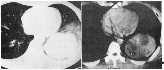 Fig.  3.  A .  Large  mass  in  left  lower  lobe  reveals  round  m argin  and  periphe ra l  irregular  haziness  around  the  mass  (6.8 x 9.5 x 5.3  cm)