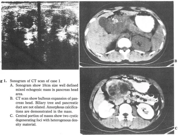 Fig  1.  Sonogram  of  CT scan of  case  1 