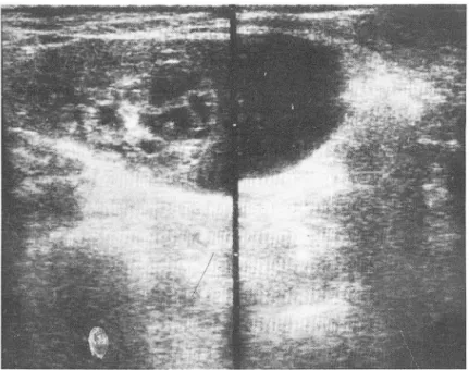 Fig 2.  A &amp;  B:  Cystic component of mass lesion is  hardly differentiated from ascites in lesser sac