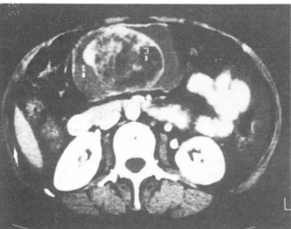 Fig 3.  Solid component of the mass lesion with surroun- surroun-ding cystic component