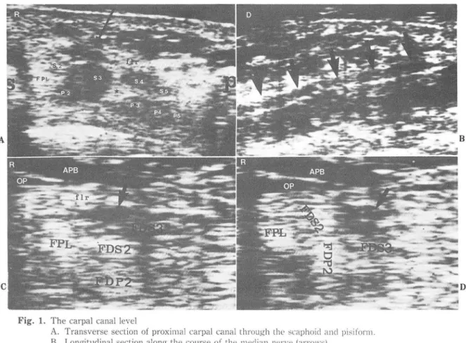 Fig.  1.  The carpal  canal  l evel 