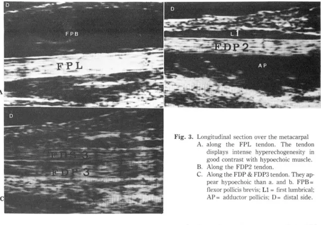 Fig.  3.  Longitud inal section  over  the  m etacarpal  A.  along  the  FPL  tendon 