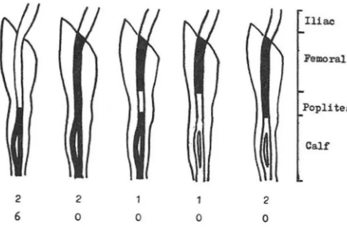 Fig.  2.  Anatomic Variation of Superficial  Femoral  Vein  (SFV)  and  Popliteal  Vein  (PV):  A