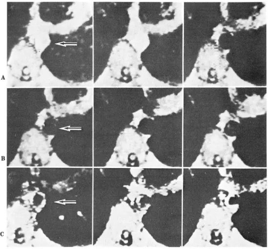 Fig.  1.  Serial ECG-gated MR  image  of descending thoracic aorta of a norma l adul t