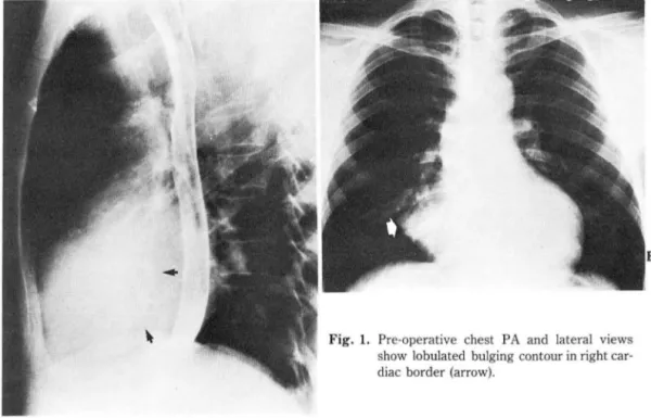 Fig.  1.  Pre-operative  chest  PA  and  latera l  views  show  lobulated  bulging  contour in  right  car-diac  border (arrow)