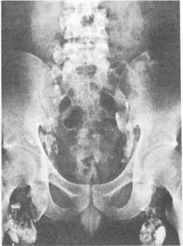 Fig.  2.  Non-Hodgkin ’ s  lymphoma 