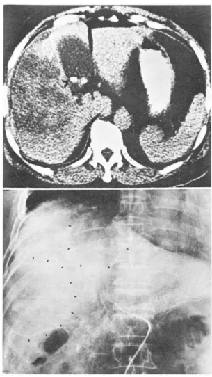 Fig.  3.  A.  Post-contrast  CT:  Isodensity mass with  bulg- bulg-ing  contour ,  right  lobe  of  liver  (dotted area)