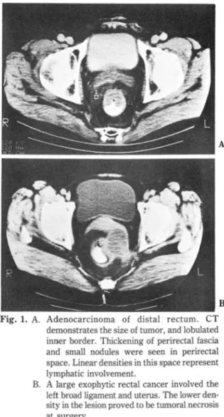 Fig.  L  A.  Adenocarcinoma  of  distal  rectum.  CT  demonstrates the size of tumor ,  and lobulated  inner borde r