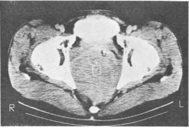 Fig_  4_  A.  Cloacogenic  carcinoma infiltrating  the  entire  wal l.  Thickening of perirectal fascia and tumor  invasion to uterus were confirmed at surgery