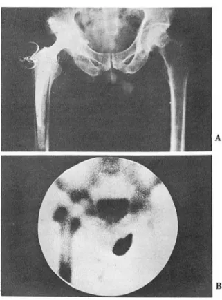Fig.  1.  Loosening  of the femoral  component 