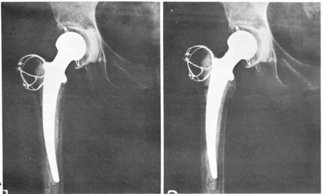 Fig.  2.  •  Loosening  of  the femoral  componen t:  Progressive widening  of  bone-cement  interface