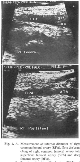 Fig .  1.  A.  Measurement  of  internal  diameter  of  right  common femoral  artery (RFA)