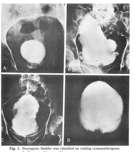 Fig.  1.  Neurogenic  bladder was  classified  on voiding cystourethrogram ,  A ,  Contracted  hypertrophic  type , 