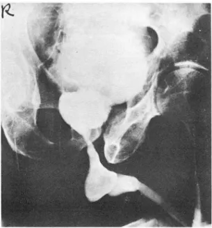 Fig.  4.  V.C.U.  shows  multiple  saccular  dilatations  at  posterior urethra 