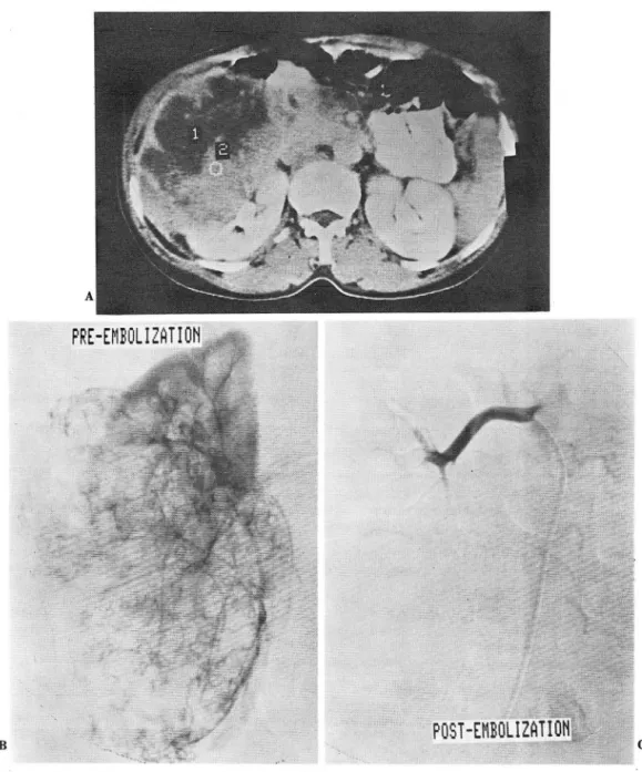Fig.  1.  Preoperative  embolization  with Ivalon  and  Gelfoam 