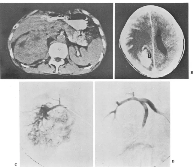 Fig. 2.  Palliative  embolizatión  with  ethano l. 