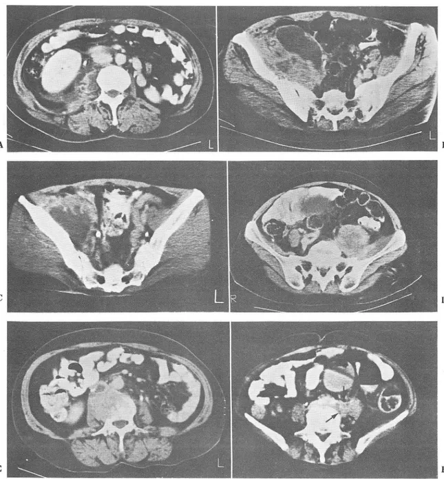 Fig.  1.  Pattems of  iliopsoas  involvemept  in  ceπlX  cancer. 